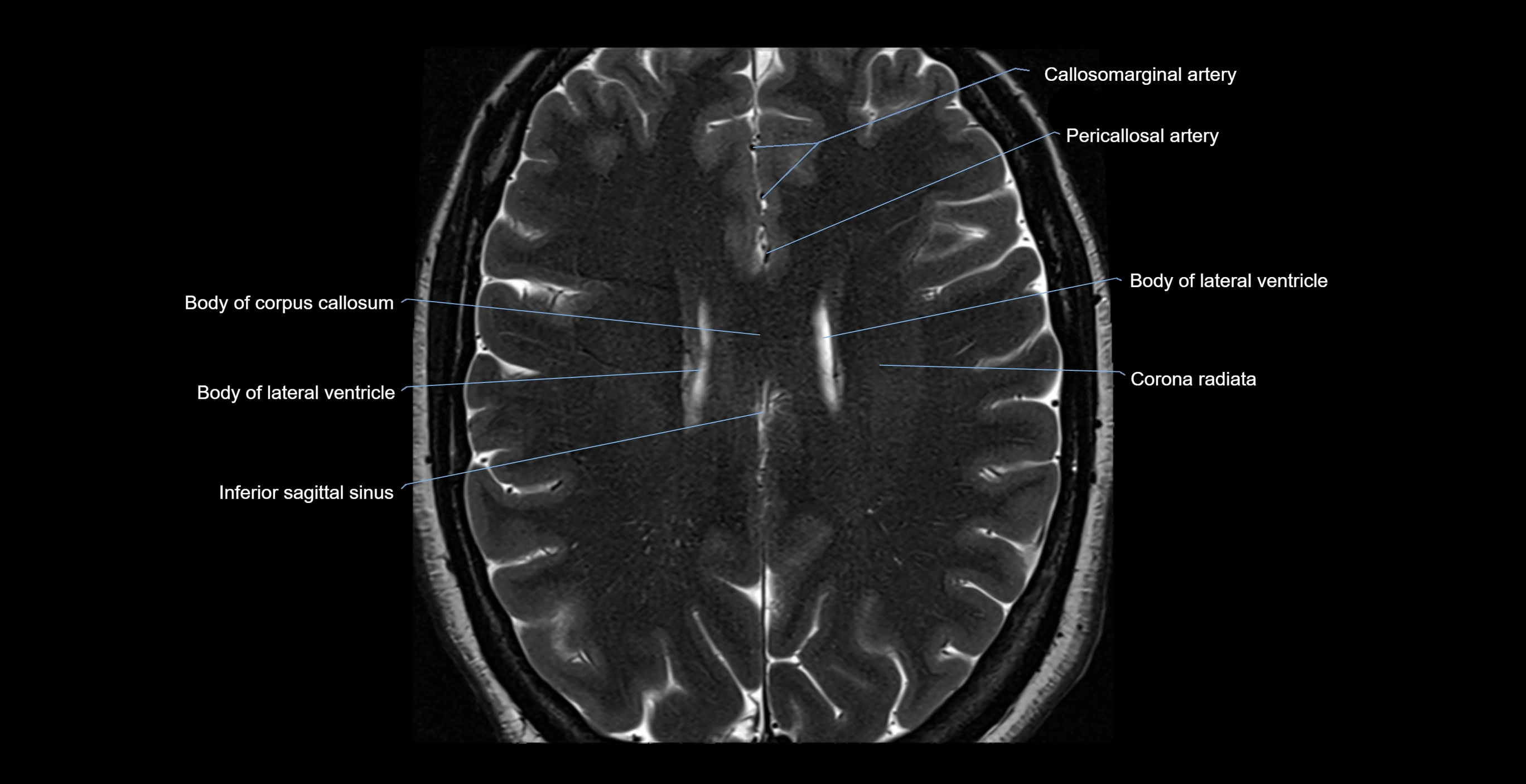 brain axial anatomy 3T MRI images -img-17001-00043.webp